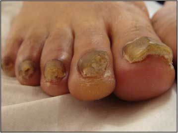 Patches Anti-Mycose des Ongles – ELAIMEI (21 pièces)