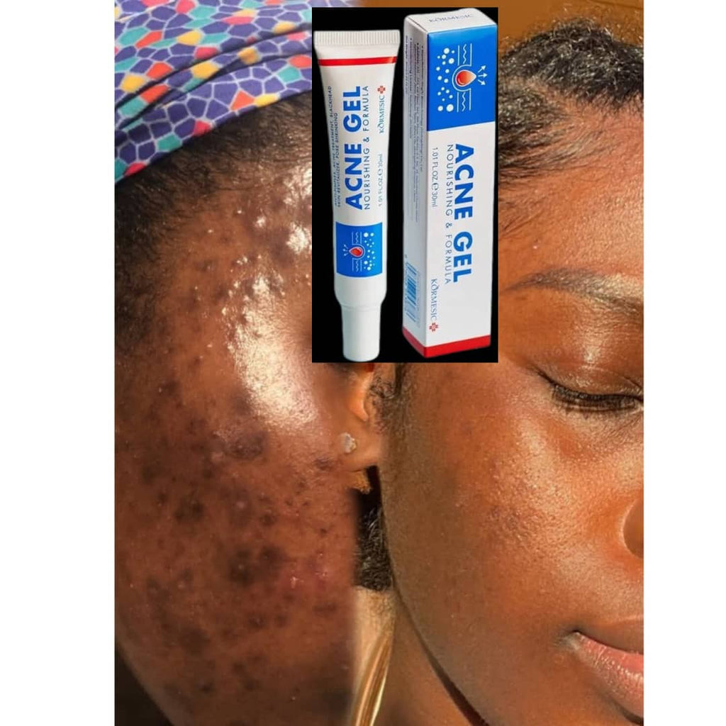 Acne Gel