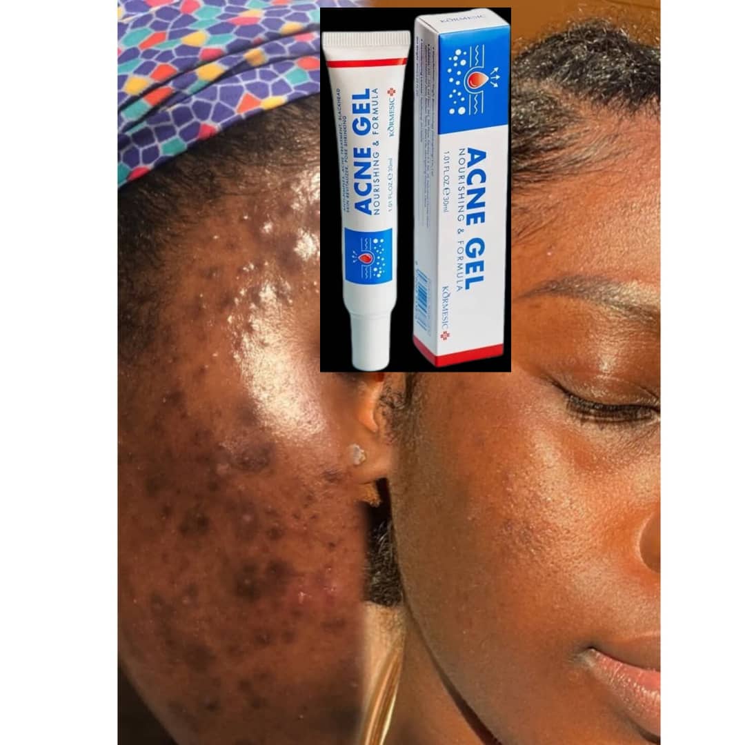 Acne Gel