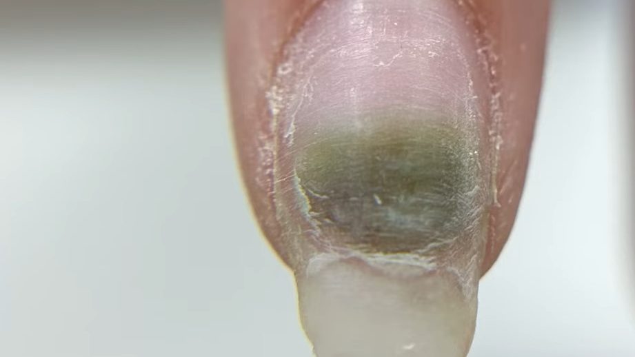 Comment retrouver des ongles saints de manière naturelle (même si vous souffrez depuis des années)