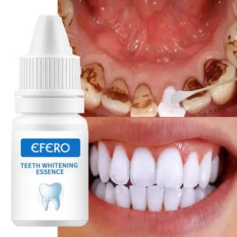 Avec EFERO retrouvez un sourire éclatant en quelques jours !